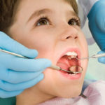 Terapia ortodontica intercettiva o precoce nei bambini .